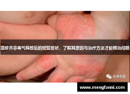 湿疹并非毒气释放后的短暂症状，了解其原因与治疗方法才能根治问题